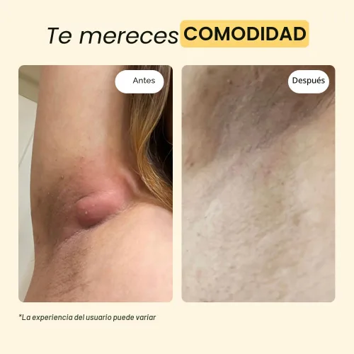 Vista 4 de MyMagicHealer Universal Flare Care Pomada Extractora para HS, forúnculos, quistes, hemorroides, quiste pilonidal, absceso Anti-rozaduras