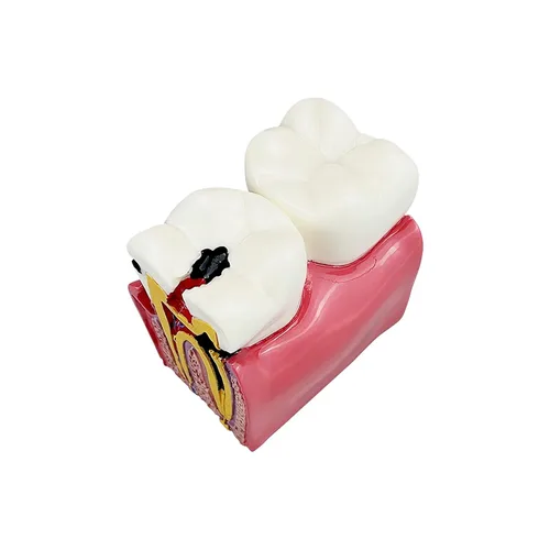 Vista 7 de Modelo de dientes de caries dental, modelo YOUYA DENTAL 6 veces de dientes de caries modelo de anatomía dental para educación de dientes