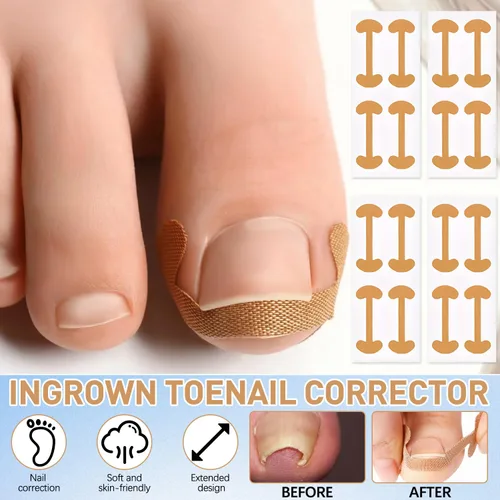 Vista 5 de Juego de corrector profesional de uñas encarnadas con tiras correctoras, kit de eliminación de uñas encarnadas, juego de herramientas de pedicura