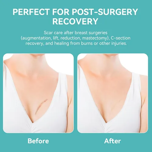 Vista 5 de Láminas de silicona para cicatrices de mama - 6 parches con forma de ancla Medical Grade Silicone, Hypoallergenic & Reusable for Breast Lift