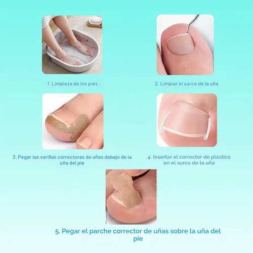 Vista 4 de Juego de corrector de uñas encarnadas con parche de corrección de uñas curvas, kit de eliminación de uñas mejorado, herramientas de pedicura