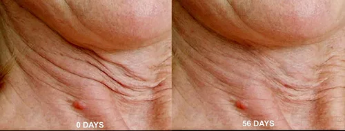 Vista 5 de Magic Serum-No Needle Alternative-BioActive Argireline Peptides Complex Anti-Eexpression Line/Creases Serum-Matrixyl 3000, SNAP-8, Pentapeptide-18