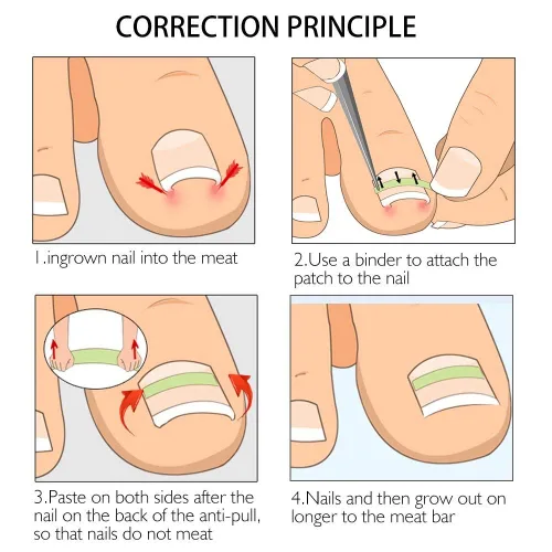 Vista 5 de Tiras correctoras de uñas encarnadas Brace 10 unids/botella enderezadora clip curvado BS Brace uñas de los pies gruesa corrección herramienta de pie