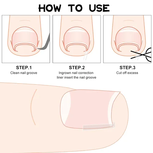 Vista 3 de 60 tiras correctoras de uñas encarnadas, corrección de uñas encarnadas, corrección de uñas, clip para enderezar uñas, parche curvo corrector de uñas