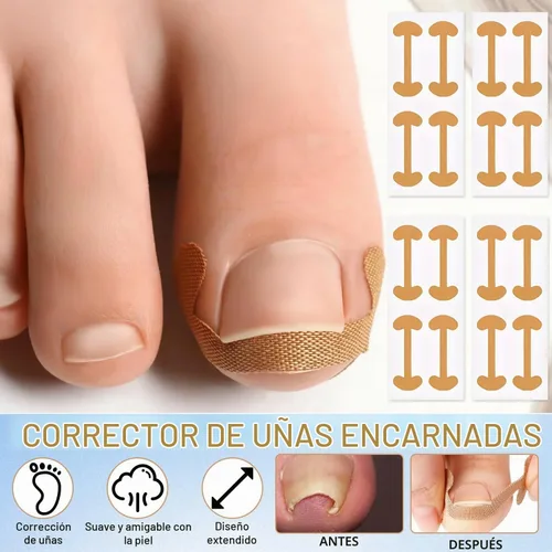 Vista 4 de Juego de corrector de uñas encarnadas con tiras correctoras, kit de eliminación de uñas encarnadas, parche corrector, herramientas de pedicura