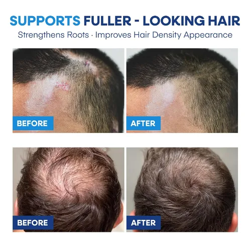 Vista 6 de Champú medicado para la dermatitis seborreica del cuero cabelludo y la psoriasis: Fórmula a base de plantas alivia la picazón, reduce las escamas