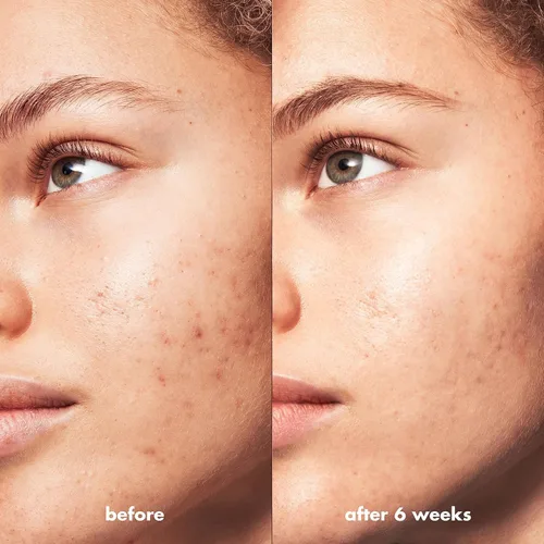 Vista 5 de e.l.f. SKIN Blemish Breakthrough Limpiador aclarador, limpiador de gel para eliminar el maquillaje, controlar el aceite y aclarar los poros, 1%