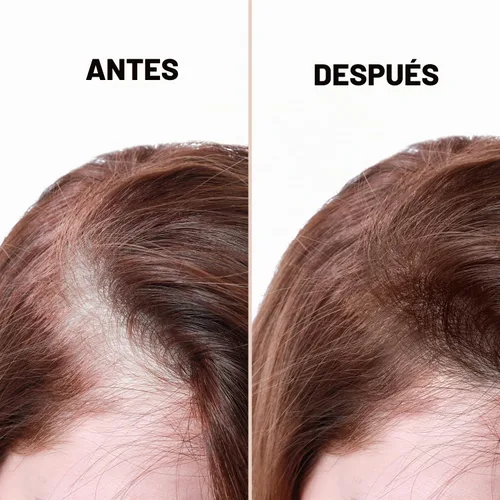 Vista 5 de Tratamiento calvicie. Crema manchas cuero cabelludo.