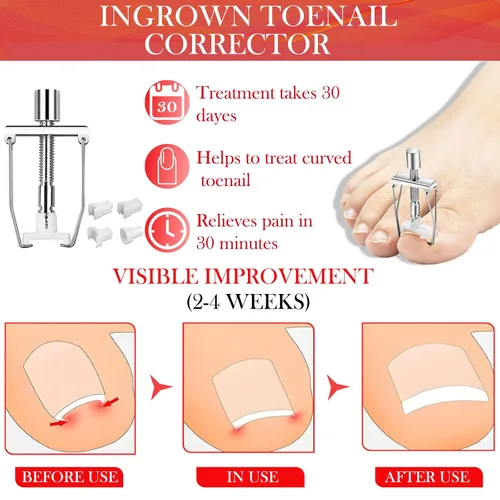 Vista 4 de Kit de eliminación de uñas encarnadas, tratamiento profesional de uñas encarnadas, kit de herramientas de uñas encarnadas con gotas correctoras