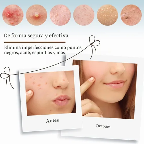 Vista 6 de MORGLES Herramientas para eliminar puntos negros, 15 piezas, kit de herramientas para reventar espinillas, extractor de espinillas de comedón