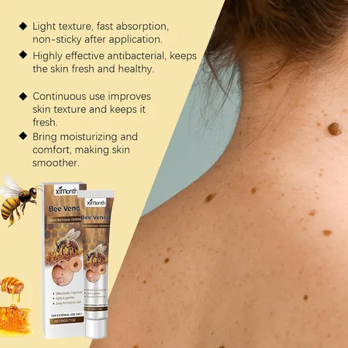 Vista 2 de Crema de veneno de abeja de acción rápida para verrugas, removedor de verrugas de ácido salicílico, indoloro y no irritante, aerosol de tratamiento