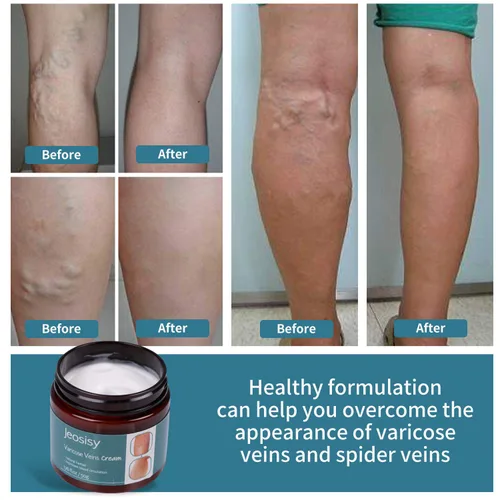 Vista 3 de Crema para venas varicosas - Crema para venas varicosas para piernas, varices y arañas vasculares crema calmante para piernas (azul claro, 1.76 oz)