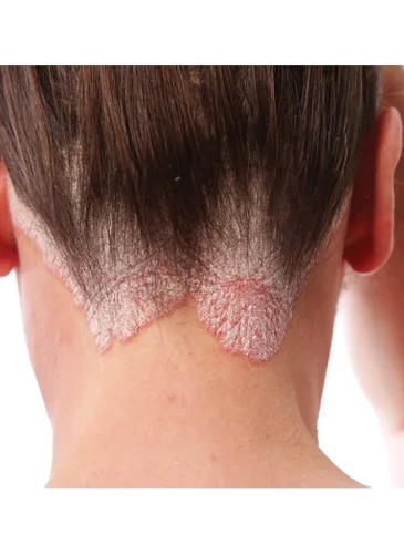 Vista 2 de TriDerma Champú exfoliante para el cuero cabelludo para control de la psoriasis, ácido salicílico al 3% para psoriasis, dermatitis seborreica