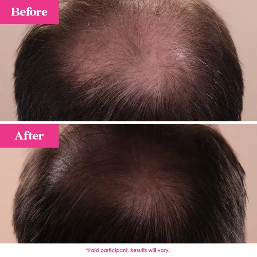 Vista 6 de Grande Cosmetics GrandeHAIR - Suero potenciador del cabello para hombres y mujeres, promueve el grosor en el cabello fino, seguro para cabello teñido