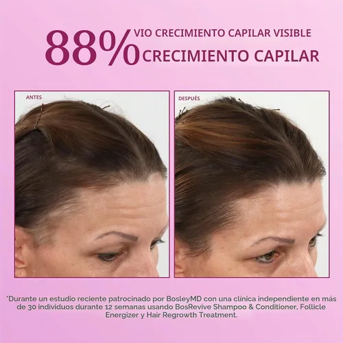 Vista 5 de BosleyMD Spray de minoxidil al 2%, tratamiento de adelgazamiento/laca para el cabello para la pérdida de cabello y el crecimiento del cabello