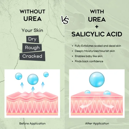 Vista 4 de Crema de urea 42% para pies, ácido salicílico, 4 onzas, removedor de callos mejorado para pies, rodillas y codos, hidrata y suaviza la piel, exfolia