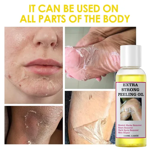 Vista 5 de Aceite de pelado para piel oscura, aceite de pelado amarillo, aceite de pelado fuerte, solución exfoliante de pelado extra fuerte para máscara