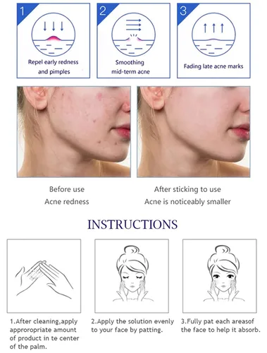 Vista 6 de AICHUN BEAUTY El ácido salicílico del extracto del aloe vera del suero facial anti-acné repara la piel dañada 1.0 fl oz