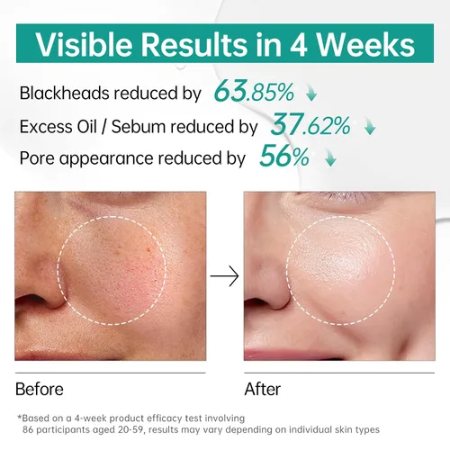 Vista 5 de BOLI Suero de ácido azelaico para cara, esencia equilibrante suavizante con ácido saicílico niacinamida retinol (1.01 fl oz)