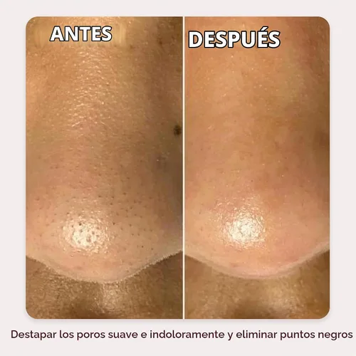 Vista 5 de DERMAFLASH DERMAPORE+ Dispositivo de cuidado de la piel, extractor ultrasónico de poros 2 en 1 e infusor para el cuidado de la piel, rubor
