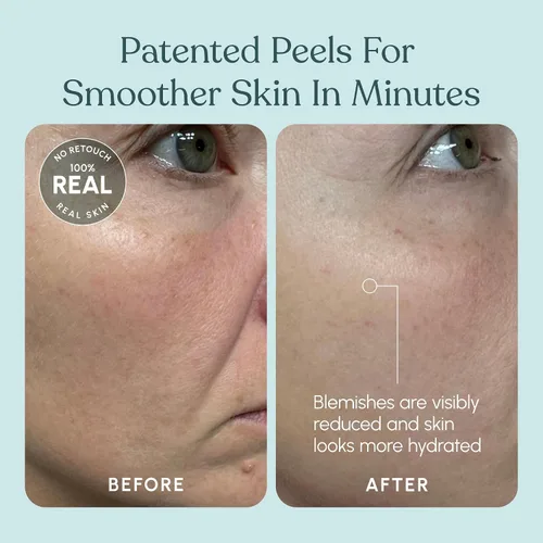 Vista 7 de 30 DAY MIRACLE AHA 30% + BHA 2% Solución de peeling – Exfoliante líquido de fuerza clínica para manchas oscuras, puntos negros y poros obstruidos