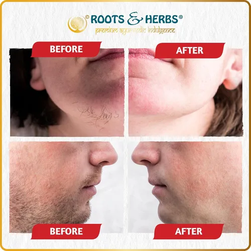 Vista 4 de Chickpea & Kasturi Turmeric - Polvo de depilación facial para hombres y mujeres, mentón, mandíbula y labios superiores, máscara depiladora