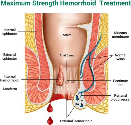 Vista 2 de LMNOOP® Ungüento para tratamiento de hemorroides, tratamiento de máxima fuerza y alivio rápido para el dolor, picazón, ardor, hinchazón, fisura