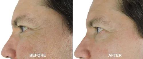 Vista 4 de DNA Code®-Sin Aguja Alternativa-Péptidos Argireline Puros Reducen Suero+Matrixyl 3000+Ácido Hialurónico