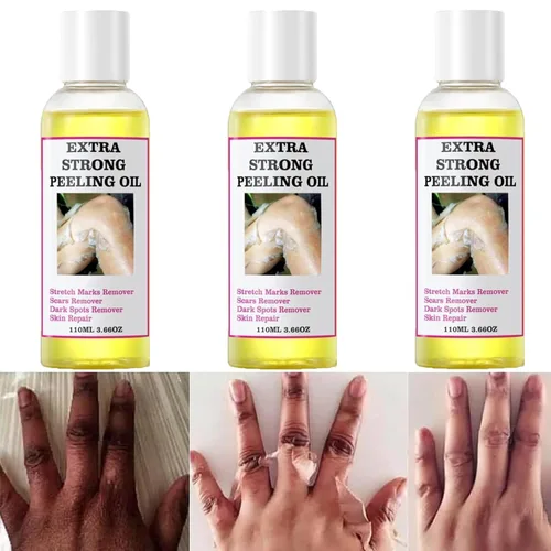 Vista 9 de Generic Aceite pelador amarillo extra fuerte para piel oscura, solución exfoliante para cuerpo, manos, pies y cara, todo