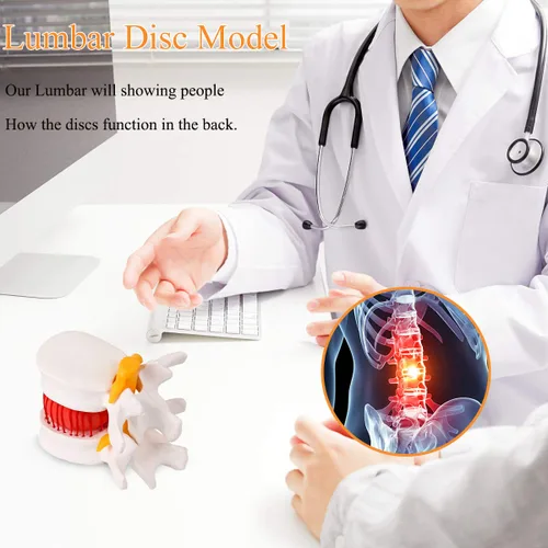 Vista 6 de Modelo de hernia de disco lumbar anatómica humana, modelo de hernia de disco lumbar de tamaño real - Modelo de columna lumbar para enseñar