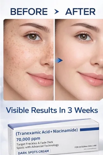 Vista 4 de Crema de ácido tranexámico Crema de pecas para la piel, manchas, antipigmentación coreana para el cuidado de la piel Cosméticos coreanos 1.7