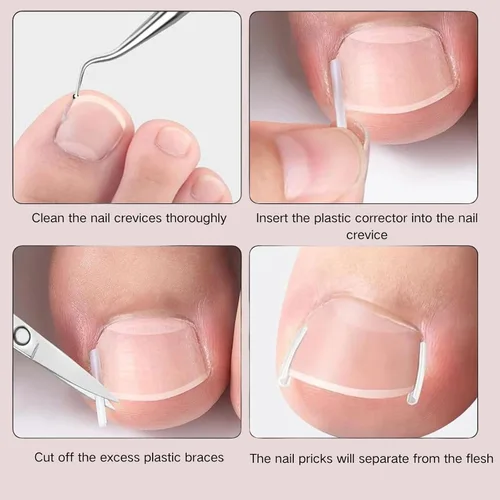 Vista 4 de Juego de corrector de uñas encarnadas con tiras correctoras, juego de herramientas profesionales de pedicura para uñas encarnadas con lima