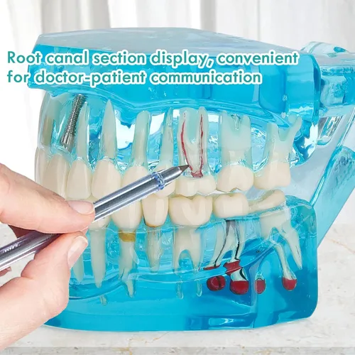 Vista 5 de Modelo de dientes de implante dental transparente - Modelo de dientes de enfermedad transparente Modelo de dientes patológicos con dientes