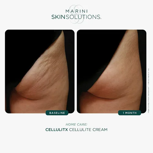 Vista 3 de Marini SkinSolutions CELLULITX