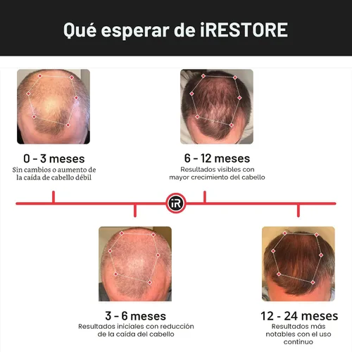 Vista 5 de iRestore Sistema de crecimiento del cabello con láser esencial: tratamientos de pérdida de cabello aprobados por la FDA para hombres y mujeres