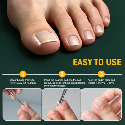 Vista 3 de FVION Juego de corrector de uñas encarnadas – 40 tiras alisadoras de uñas encarnadas sin dolor con levantador de uñas de los pies – Solución eficaz