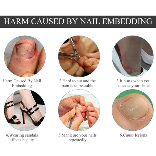 Vista 6 de Corrector de uñas pedicura herramienta de cuidado de pies, 12 unids/caja de herramienta de corrección de uñas de los pies, 6 tamaños encarnados