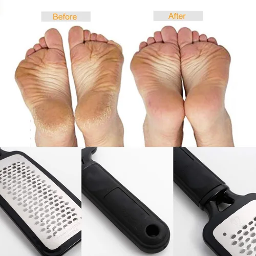 Vista 6 de Removedor de callos para pies, raspador de pies colosal y kit profesional de pedicura para eliminar la piel dura para pies húmedos y secos, lima