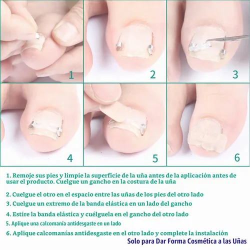 Vista 4 de Kit de corrección de uñas encarnadas Professional Nail Care Tools, Correction Clips and Adhesive Pads, Four Correction Clips, Correct Two Toenails