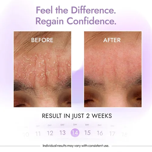 Vista 5 de DERMAdoctor - Limpiador de tranquilidad de zinc piritiona al 2%, máxima fuerza OTC para dermatitis seborreica, caspa y enrojecimiento Cara, cuero