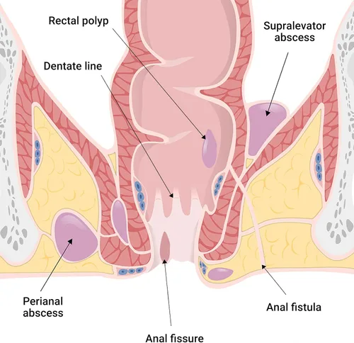 Vista 4 de LMNOOP® Crema de cuidado perianal, heridas de curación rápida para fisura del ano, absceso, úlcera, infección, cirugía posparto y fístula anal