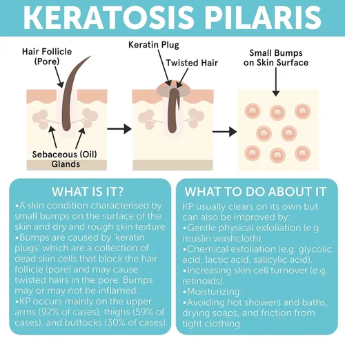 Vista 6 de Tratamiento de queratosis pilaris Loción de queratosis pilaris con 10% AHA Exfoliación suave para piernas de fresa, KP y pelos encarnados