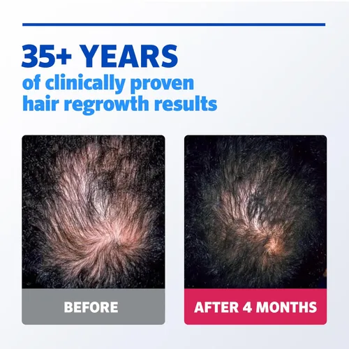 Vista 4 de Solución Rogaine para hombres, suministro de un mes