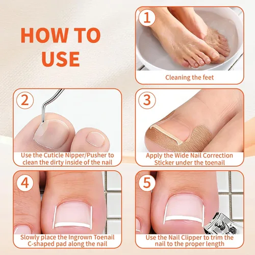 Vista 5 de Kit de eliminación de uñas encarnadas, kit de herramientas de uñas encarnadas con tiras de corrección de uñas encarnadas, separadores de dedos, lima
