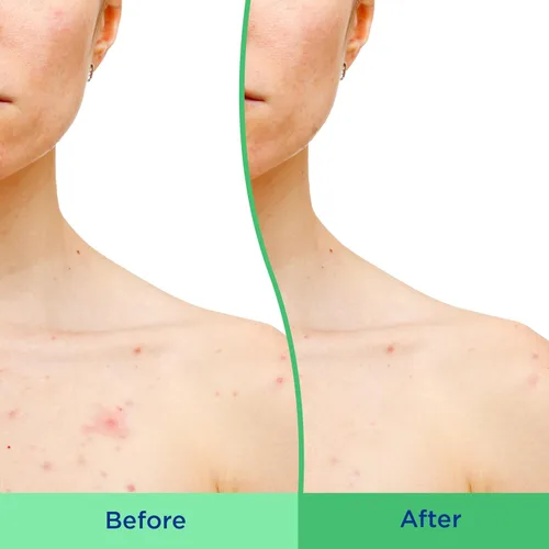 Vista 4 de Differin - Exfoliante corporal con ácido salicílico para eliminar el acné, mejora el tono y la textura de la piel en los hombros y el pecho, 8 onzas