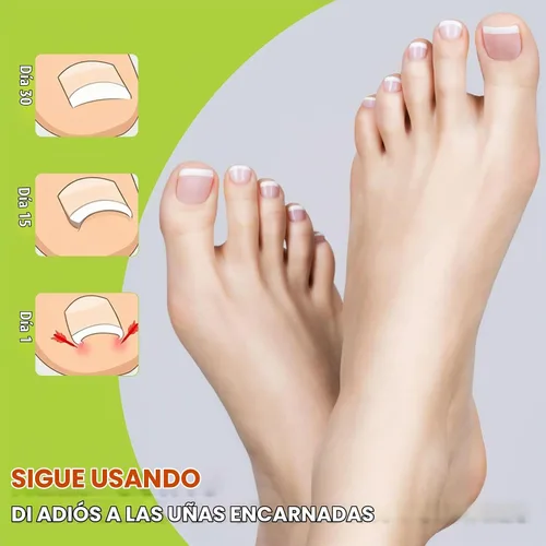Vista 4 de Kit corrector de uñas encarnadas, herramientas de uñas, tiras de corrección transpirables con herramientas de levantamiento de uñas, cortaúñas
