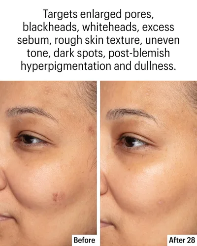 Vista 3 de Allies of Skin Suero aclarante facial azelaico y kójico Clínicamente probado para piel propensa al acné y a las imperfecciones 10% ácido