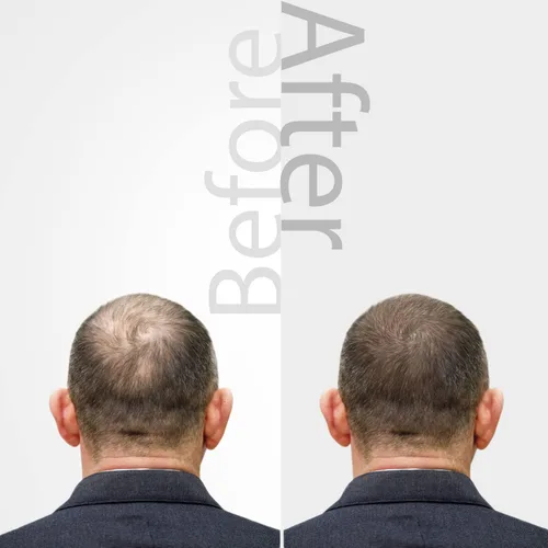 Vista 6 de The Mossi London - Suero ozonizado para el cabello y el cuero cabelludo - Tratamiento de aceite de oliva ozonizado al 50% para hebras de aspecto más