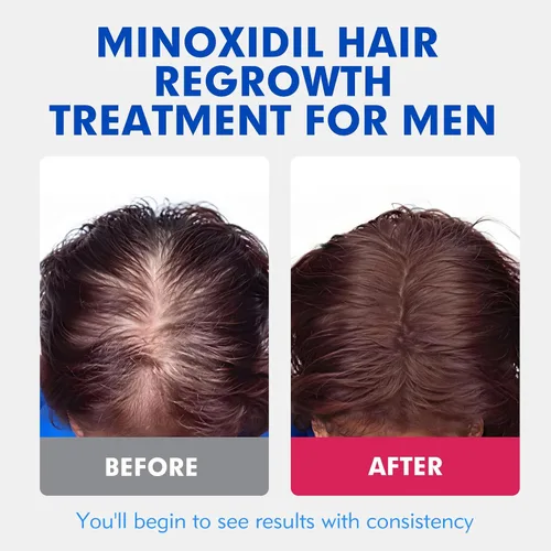 Vista 9 de Fytikal 5% de minoxidil para hombres tratamiento de crecimiento del cabello, solución tópica extra fuerte para adelgazamiento del cabello