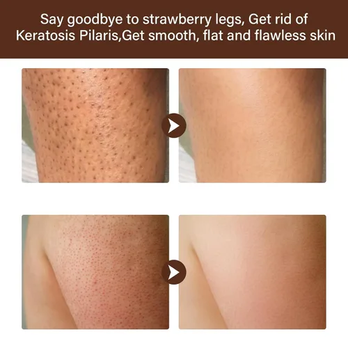 Vista 3 de Tratamiento de piernas de fresa, crema rejuvenecedora de piel de brazo de fresa con niacinamida, tratamiento hidratante de piel de pollo